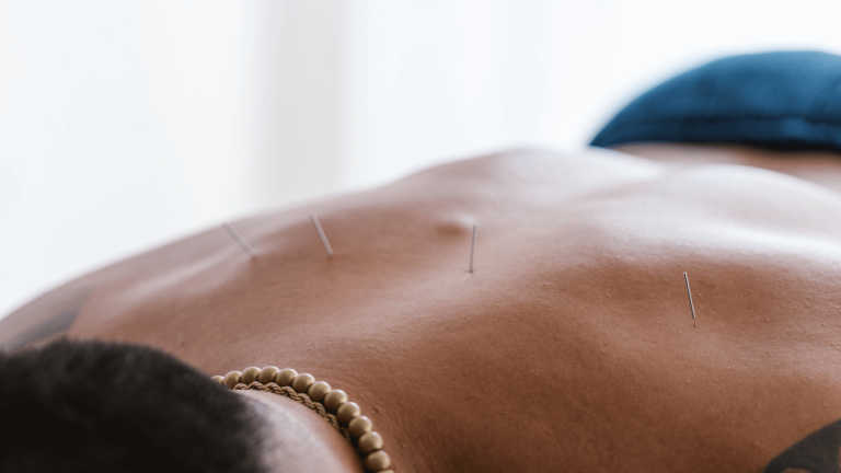 Séance-Acupuncture